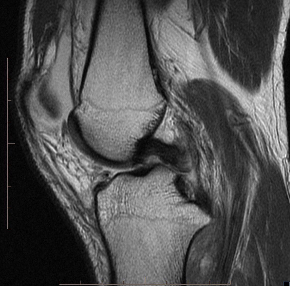 Figure 2 for case PCL tear